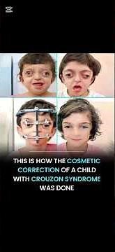 Crouzon Syndrome: Multidisciplinary Surgical Management 👁️🧠🦷