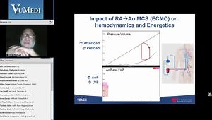 Percutaneous Ventricular Assist Devices for Heart Failure