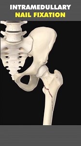 Intermedullary Nail Fixation 3D Animation #intermedullarynail #brokenfemurbone #femurbone #femurbones #femurbonetreat #fracturedfemurbone #medical3danimation #3dmedicalanimation #fixation | Mix Dancing Events