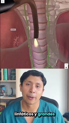 La mediastinoscopía permite explorar el mediastino y evaluar estructuras internas del tórax. #torax