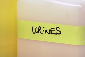 Pourra-t-on détecter le cancer de la vessie grâce à un simple test urinaire ?