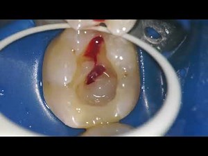 PULPITIS ENDODONTIC TREATMENT ROOT CANAL Intrapulpal anestesia HOT TOOTH