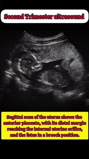 Second Trimester ultrasound.Placental Localization.