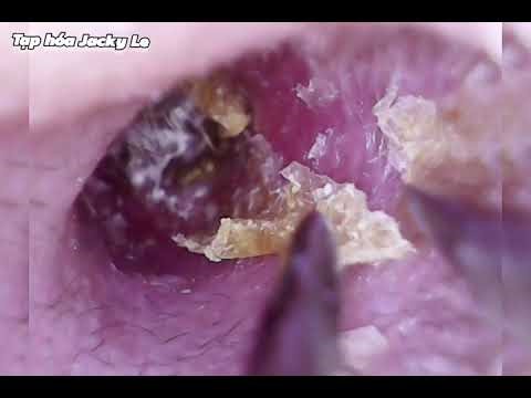 Lấy Ráy Tai Thư Giãn 01