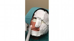 Laser Pearl Fractional for Acne Scars: See This Man's Treatment (Part 2)