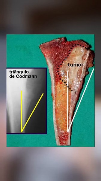 El triángulo de Codman y su relación con el osteosarcoma