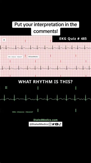 🫨🫀🤔 All #EKG recordings are from the EKG rhythm generator on my website (LII rhythms only for now, 12Ls are in beta and coming soon), be sure to check it out for more software generated ECG practice! (Link in bio.) #EMS #paramedic #nurse #doctor