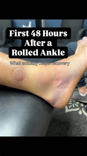 Athletic Edge Physical Therapy on Instagram: "Rolled your ankle? The first 48 hours can change your entire recovery. An ankle sprain isn’t just swelling and bruising, early changes in tissue quality, motion, and balance can set the tone for how your ankle heals weeks later. This reel shows what early physical therapy for a rolled ankle can include: • Managing swelling to protect joint motion • Addressing calf stiffness that limits ankle movement • Supporting tissue healing with targeted modaliti