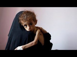 Children affected by famine in Yemen