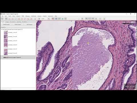 Pixel classification with QuPath (epithelium and stroma segmentation with H&E images)