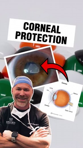 During general anesthesia, patients lose their natural reflexes, including blinking, which is vital for maintaining eye moisture and protection.…Without regular blinking, the eyes can dry out, leading to corneal abrasions or other eye injuries.…To prevent these complications, ointment is applied to the patient’s eyes.…#EyeProtectionInSurgery #AnesthesiaEyeCare #SurgicalEyeSafety #PreventingCornealAbrasions #HealthyEyesInOR #brownsanatomy | Ricky Brown