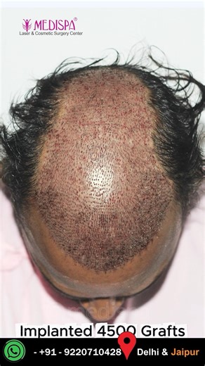 4500 Grafts Grade 5 | Hair Transplant Results | Dr Suneet Soni
