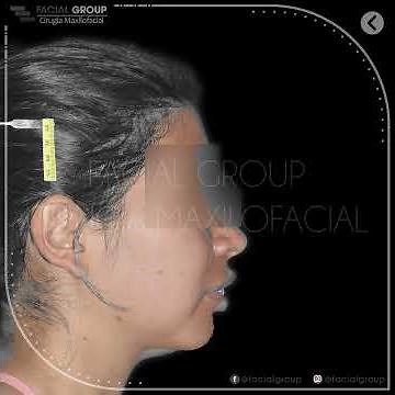 Corrección de exceso vertical de maxilar superior