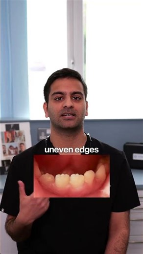 What is Composite Bonding?