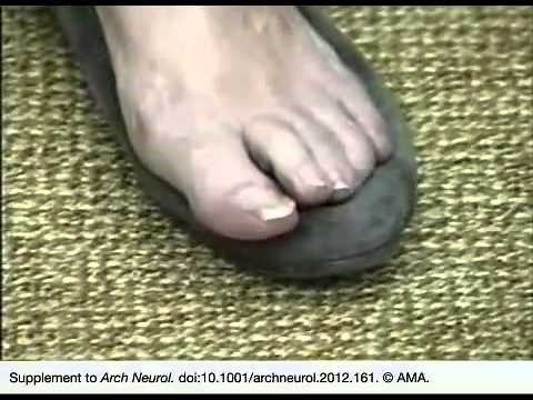 Painful Legs and Moving Toes Syndrome