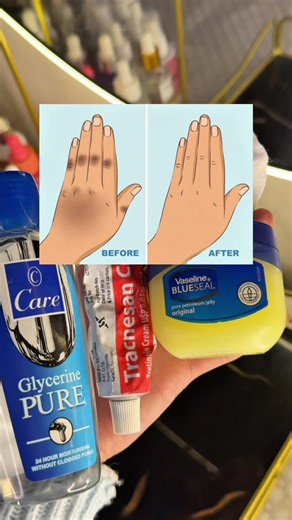 Effective Solutions for Dark Knuckles Treatment