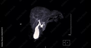 Magnetic resonance cholangiopancreatography or MRCP 3D MIP view showing visualize the biliary and pancreatic ducts .