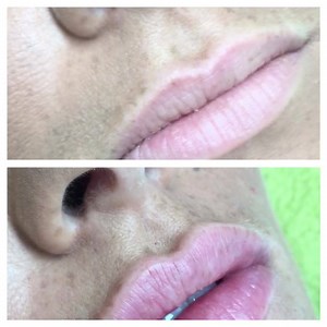 How amazing are these set of lips 💉💄👄 Before & After 💉💄👄 | K Aesthetics Training Academy
