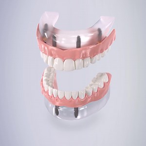 23 shares · 4 comments | Introducing Implant Dentures. Now you can eat what you want. Smile how you want. All for the price you want. | Aspen Dental | Facebook