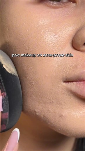 Textured skin is a struggle🥲