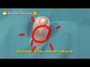 เจาะฝีหนองที่เท้า