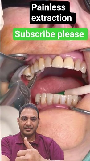 painless tooth extraction