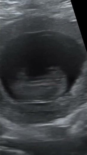 our little one moving, early scan 10weeks 1 day #pregnant #pregnancy #babyontheway #10weeks