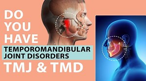 A case review by one of our recent patients Mr. Rajshekhar from Karnataka who had great results with his TMJ treatment at FMS Dental. Rajshekhar was suffering from TMJ pain that was debilitating, making it tougher to eat/chew food and was refered to FMS Dental. See what a difference FMS Dental TMD treatment approach made in his life. Signs of TMJ pain are headaches, grinding & eating discomfort. To get relief from TMJ/TMD visit FMS Dental #TMDclininic today! Call/Whatsapp at 91 8885060770 or 👉 