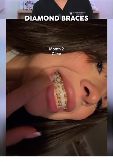 Why Gold Braces Are Eye-Catching and Affordable