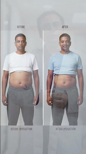 Liposuction for Stubborn Tummy Fat: Procedure Explained