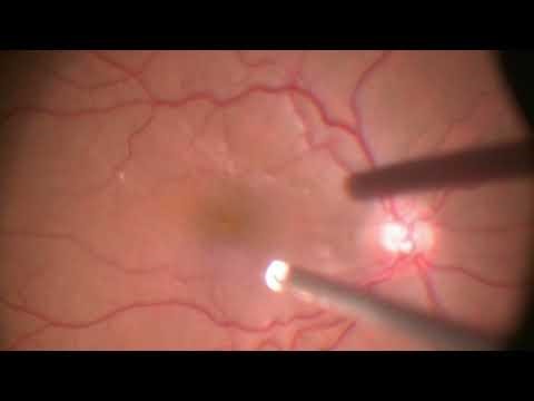 Vitrectomy for Epiretinal membrane removal | Epiretinal membrane| Dr Manish Nagpal