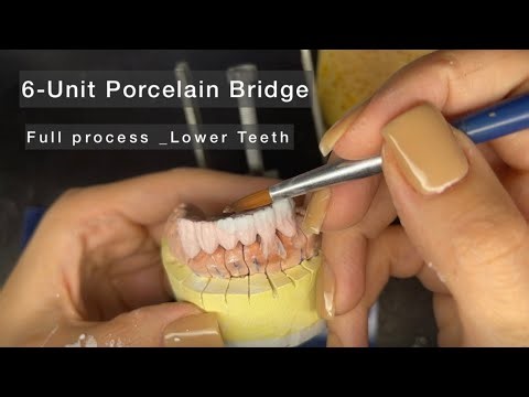 Satisfying Porcelain Veneer Placement – 6 Lower Teeth Transformation