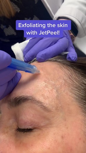 The JetPeel works like a power washer for the face! Look at that dead skin flying right off! 🤯 #fyp #viral #skincare #esthetician #exfoliation #jetpeel #esthitok #powerwashing