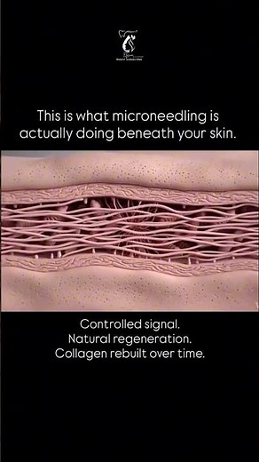 Microneedling Explained | What Happens Under Your Skin & How Collagen Boosts