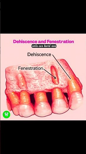 Dehiscence vs Fenestration