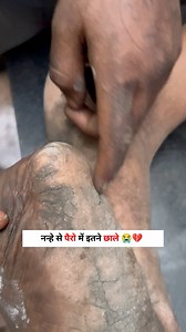 नन्हे से पैरो के छाले देखकर रोना आ गया 😭😭💔#umeshhelpinghand #poorlife #cutechild #emotions #instagram #fbreels #fbreels2024 #explore #viral Popatbhai Charitable Foundation | Umesh Kumar