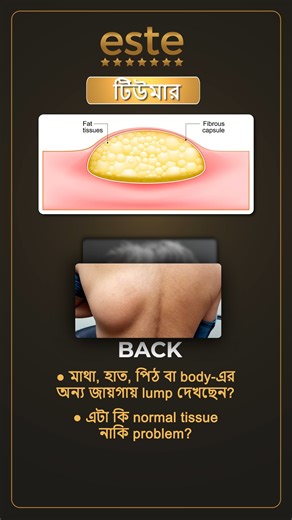 Este Aesthetic Hospital on Instagram: "✨ Safe & Smooth Lipoma Surgery at Este ✨ Lipoma মানে শরীরের নিচে হওয়া একটি soft fatty lump — যা দেখতে বা feel-এ uncomfortable লাগতে পারে। Este Lipoma Surgery এই lipoma গুলোকে safely remove করার জন্য একটি advanced surgical solution, যেখানে focus থাকে minimal scar, fast recovery & clean results ✔ Lipoma safely remove করা হয় ✔ Minimal cut, minimal scar ✔ Expert surgeons দ্বারা performed ✔ Hygienic OT & advanced surgical setup ✔ Comfortable procedure & smooth