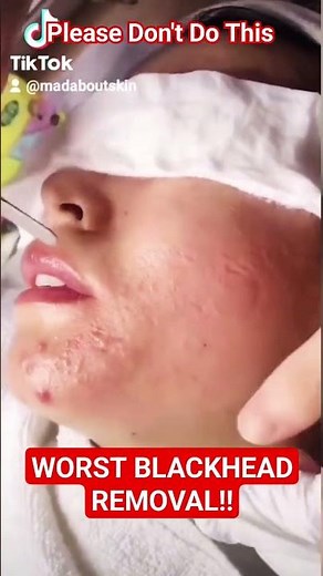 ❌ Worst BLACKHEAD REMOVAL Technique #shorts