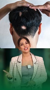 10K views · 110 reactions | Alopecia Areata Treatment #alopecia | Dr Miami | Facebook