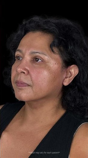 🤩𝐖𝐡𝐞𝐧 𝐭𝐞𝐜𝐡𝐧𝐢𝐪𝐮𝐞 𝐢𝐬 𝐦𝐞𝐭𝐢𝐜𝐮𝐥𝐨𝐮𝐬, 𝐫𝐞𝐬𝐮𝐥𝐭𝐬 𝐬𝐩𝐞𝐚𝐤 𝐪𝐮𝐢𝐞𝐭𝐥𝐲!🤩