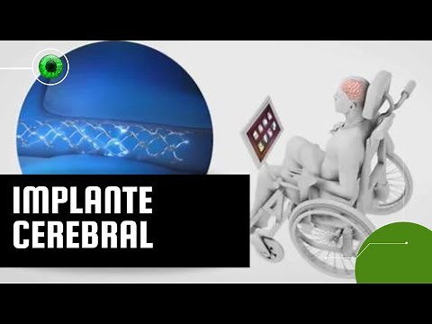 Chip implantado no cérebro é capaz de "ler pensamentos"