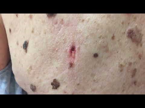 Dr Pimple Popper Removes Deep Back Lesion with Curette