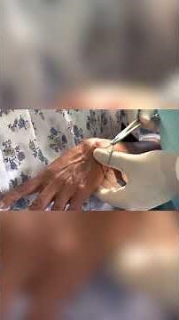 Treatment for Ganglion cyst using seton technique :Dr Benny Punchakonam