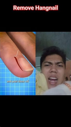 Remove Hangnail @zackdfilms