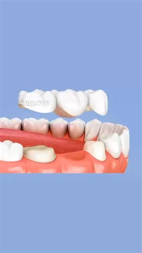 🛠️ Fill the Gap Safely! Watch How a Dental Bridge Restores Your Smile. ✅ Missing a tooth? That gap does more than hurt your confidence—it causes adjacent teeth to shift, leading to bite problems and bone loss over time. Watch this short video to see the solution: a Fixed Dental Bridge! Why Choose a Fixed Bridge? ✨ Seamless Smile: Replaces the missing tooth with a natural-looking prosthetic, blending perfectly with your remaining teeth. 🦷 Stops Shifting: It securely anchors neighboring teeth, p