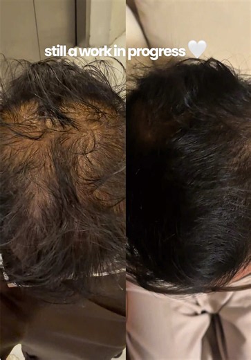 I knew my hair was getting better… but I didn’t realize it was THIS different. 😭 Hair growth progress after months of dealing with hair loss. Hair thinning is a different kind of battle that is soooo hard to deal with!