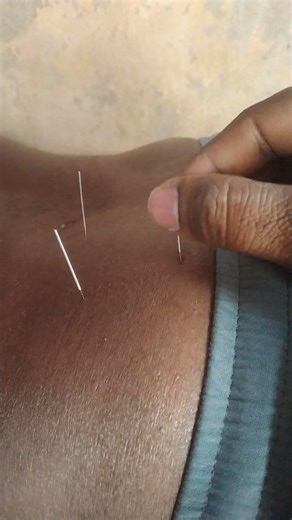 back pain for dry needling therapy ###