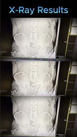 Handheld X-Ray Machine for Instant Diagnosis | STARNUKE MIN-X Pro