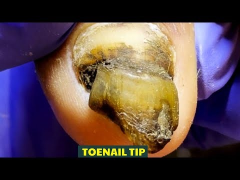 The SHOCKING Truth About Using Bleach for Toenail Fungus |【Toenail Tip】