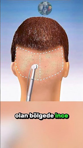 How Is Hair Transplant Done? 🧑‍🦲 ✂️